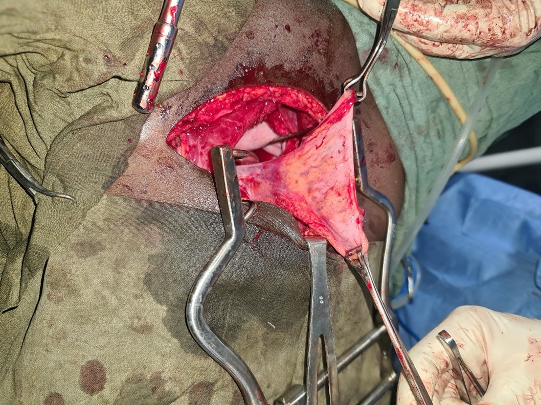 Colo-vaginal surgery