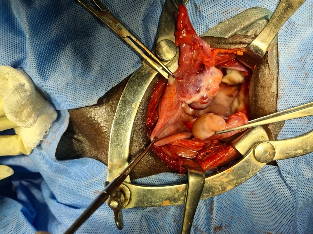 MRKH neovagina surgery