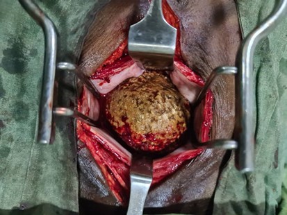 Pre-outreach surgical procedure