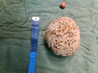 Extracted 0.6kg stone